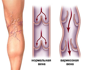 Варикозное расширение вен