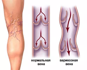 Варикозное расширение вен